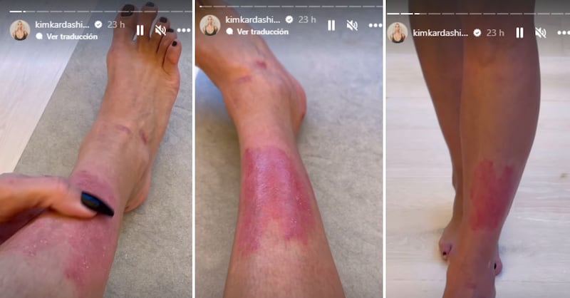 ¿Tiene cura? Kim Kardashian muestra el avance de su psoriasis y sensibiliza sobre esta enfermedad